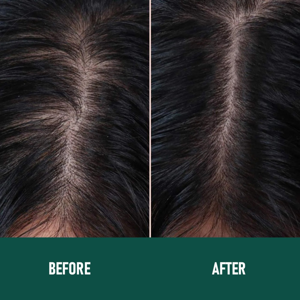 Mousse anti-chute au minoxidil pour stimuler la repousse et renforcer les cheveux